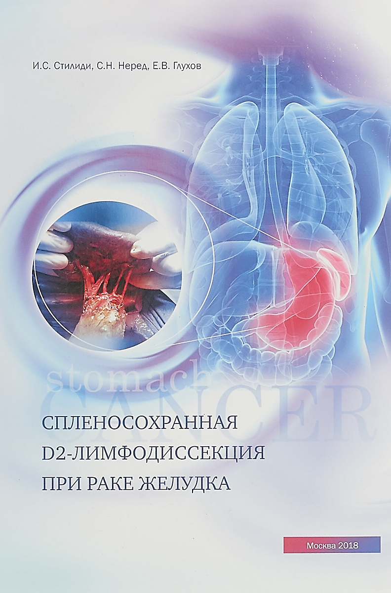 Спленосохранная D2-лимфодиссекция при раке желудка, 2018